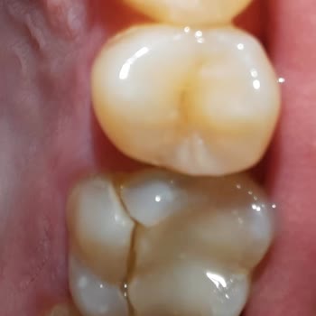 Baydent Ağız Ve Diş Sağlığı Polikliniği Kanal Tedavisi İçin Gittiğim Yer Beni Dişsiz Bıraktı