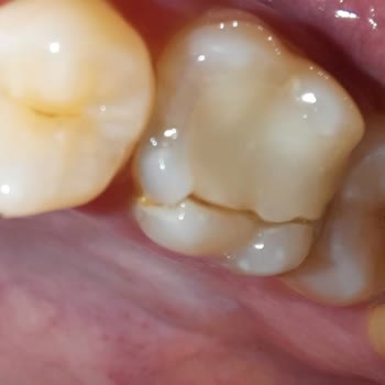 Baydent Ağız Ve Diş Sağlığı Polikliniği Kanal Tedavisi İçin Gittiğim Yer Beni Dişsiz Bıraktı