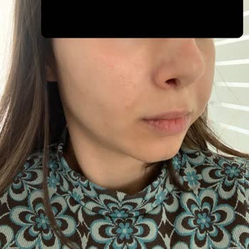 Muhittin Aktaş Yanaklarıma Fda Onaysız Vücut Dolgusu Yaptı