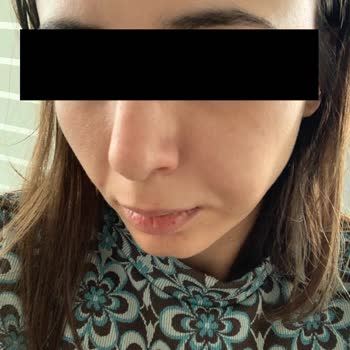 Muhittin Aktaş Yanaklarıma Fda Onaysız Vücut Dolgusu Yaptı