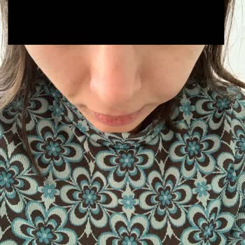 Muhittin Aktaş Yanaklarıma Fda Onaysız Vücut Dolgusu Yaptı