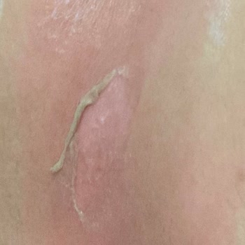 BİM Bardak Kulpunun Çıkması Ve Üstüme Sıcak Suyun Dökülmesi