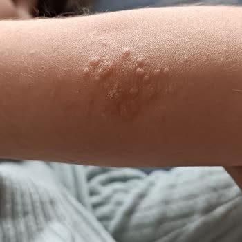 Ecowell Bebek Şampuanı Alerji Yaptı