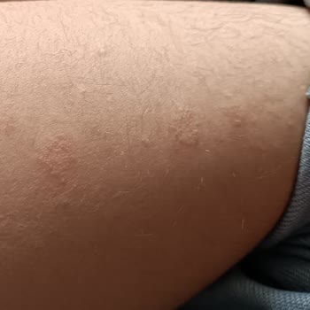 Ecowell Bebek Şampuanı Alerji Yaptı