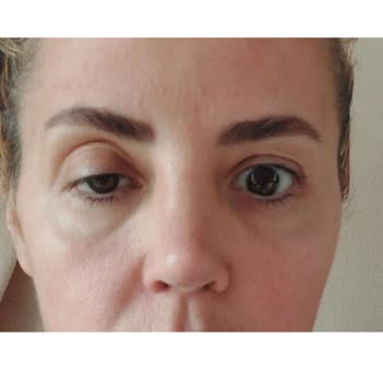 British Esthetic Botoks Ve Dolgu Mağduriyeti