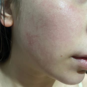 Gello Cosmetics Kil Maskesinin Suratımı Getirdiği Hal