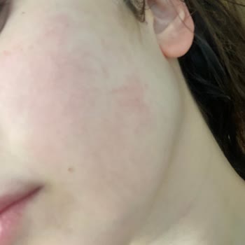 Gello Cosmetics Kil Maskesinin Suratımı Getirdiği Hal