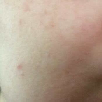 Dermoskin Arbutin Krem Yüzümde Leke Ve Kızarıklık Yaptı