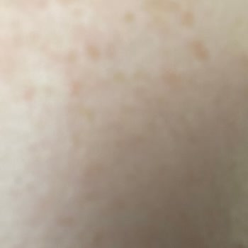 Dermoskin Arbutin Krem Yüzümde Leke Ve Kızarıklık Yaptı