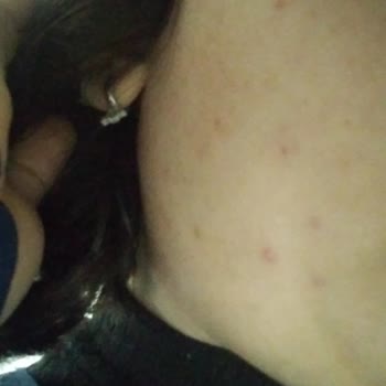 Yves Rocher Bright Botanical Krem Sivilce Yaptı