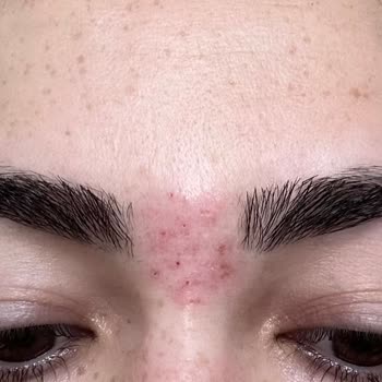 Akademi Paris Güzellik Buz Lazer İğneli Epilasyon Yanığı