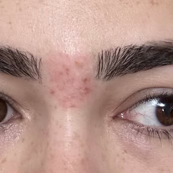 Akademi Paris Güzellik Buz Lazer İğneli Epilasyon Yanığı