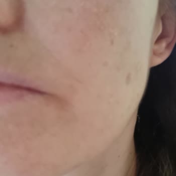 Yves Rocher Kozmetik Ürün Kullanımı Oluşan Alerji