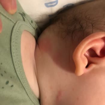 Ebebek Mama Önlüğü Alerji Yaptı