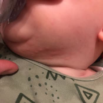 Ebebek Mama Önlüğü Alerji Yaptı