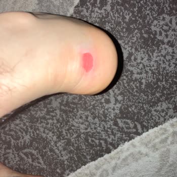 Nike Ayakkabı Yüzünden Topuk Kısmımda Deri Kalmadı