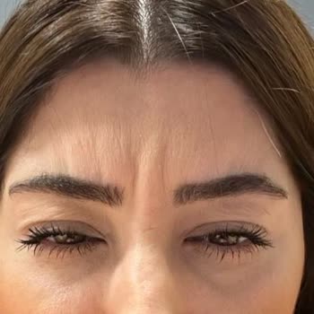 Op. Dr. Evren İşçi Botox Fiyaskosu