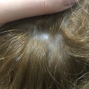 Palette Saç Boyası Kafamda Yaralar Yaptı