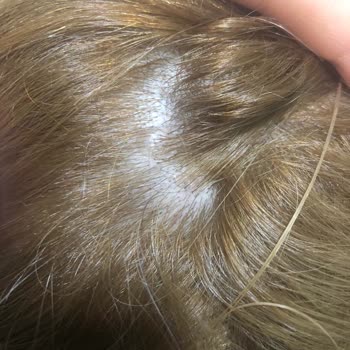 Palette Saç Boyası Kafamda Yaralar Yaptı