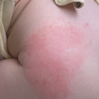 Sleepy Natural Alerji Sorunu