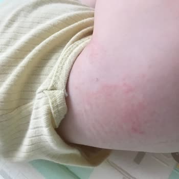 Sleepy Natural Alerji Sorunu