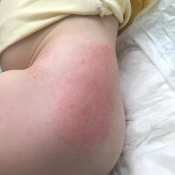 Sleepy Natural Alerji Sorunu