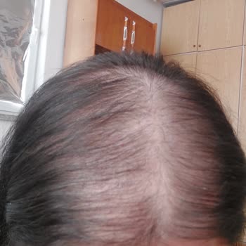 Dr. Hakan Tetik Saç Ekimi Şikayet Ektiği Saç Çıkmadı Ayrıca Çok İlgisiz