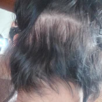 Dr. Hakan Tetik Saç Ekimi Şikayet Ektiği Saç Çıkmadı Ayrıca Çok İlgisiz