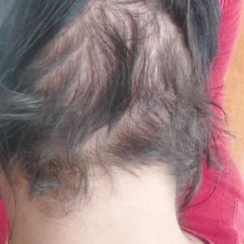 Dr. Hakan Tetik Saç Ekimi Şikayet Ektiği Saç Çıkmadı Ayrıca Çok İlgisiz