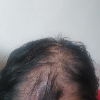 Dr. Hakan Tetik Saç Ekimi Şikayet Ektiği Saç Çıkmadı Ayrıca Çok İlgisiz