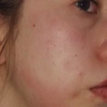 Yves Rocher Sebo Vegetal Matlaştırıcı Tonik Alerjik Reaksiyon