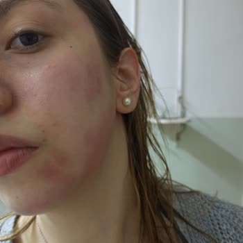 Yves Rocher Sebo Vegetal Matlaştırıcı Tonik Alerjik Reaksiyon