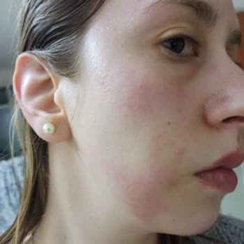 Yves Rocher Sebo Vegetal Matlaştırıcı Tonik Alerjik Reaksiyon