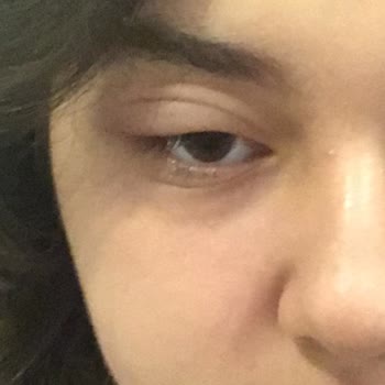 Dermoskin Yüz Temizleme Köpüğü Gözümü Şişirdi