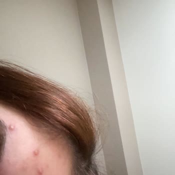 La Roche - Posay Krem Yüzümü Sivilcelendirdi