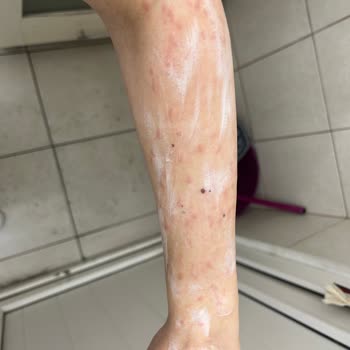 İstanbul Aydın Üniversitesi VM Medical Park Hastanesi Lazer Epilasyon Yanığı