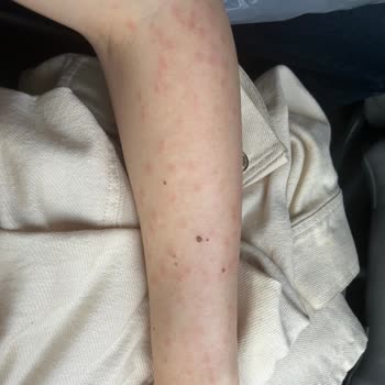 İstanbul Aydın Üniversitesi VM Medical Park Hastanesi Lazer Epilasyon Yanığı