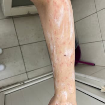 İstanbul Aydın Üniversitesi VM Medical Park Hastanesi Lazer Epilasyon Yanığı