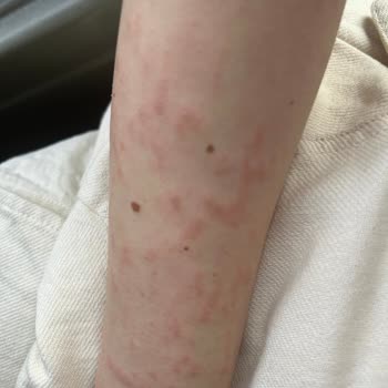 İstanbul Aydın Üniversitesi VM Medical Park Hastanesi Lazer Epilasyon Yanığı