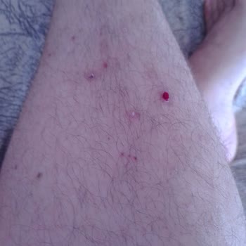 Sağlık Bakanlığı Kaşıntı Uyuz Hastalığı