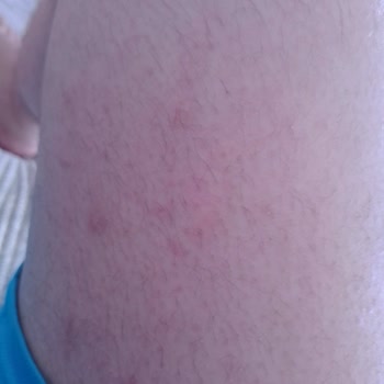 Sağlık Bakanlığı Kaşıntı Uyuz Hastalığı