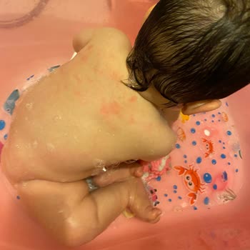 Bioderma ABC Şampuan Kızarıklık Yaptı