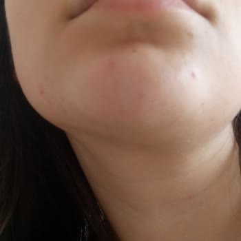 Sinoz Güneş Kremi Ağrılı Sivilce Ve Kaşıntı Yapıyor