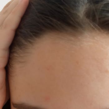 Sinoz Güneş Kremi Ağrılı Sivilce Ve Kaşıntı Yapıyor