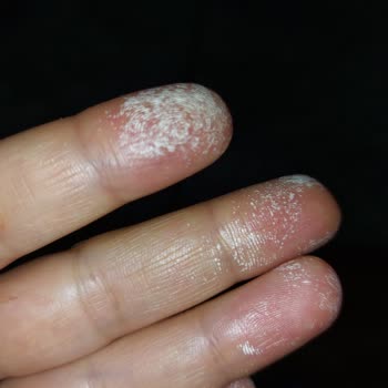 Vanish Kosla Elimde Leke Bıraktı Ve Acıyor