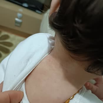 Enterogermina Kids Ürünü Çocuğumda Alerjiye Neden Oldu