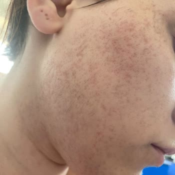 Lemus Güzellik Merkezi İğneli Epilasyon Hüsranı!