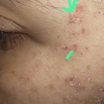 Lemus Güzellik Merkezi İğneli Epilasyon Hüsranı!