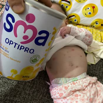 Nestlé İyi Büyüsün İyi Yaşasın Mamanız Alerji Yapıyor