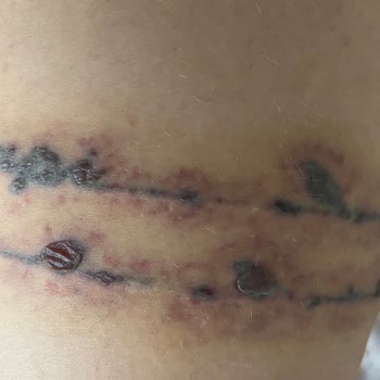 Elit. Lazertasarim Elit Güzellik Merkezi (Aydın) Dövme Silme Yanık